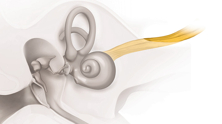 Neural Hearing Loss neaural-hearing-loss