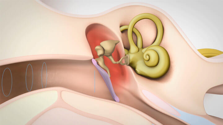 Types of hearing loss Types of hearing loss
