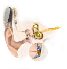Med El Cochlear Implants For Hearing Loss