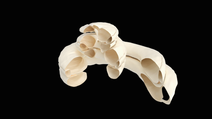 Electrode inside a cochlea Electrode inside a cochlea